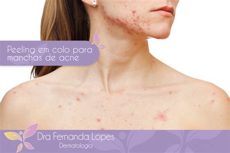 Dra Fernanda Lopes Dermatologia Blog Peeling Químico Eficaz