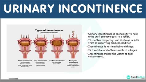 Urinary Incontinence Definition Types Causes Diagnosis And My Xxx Hot