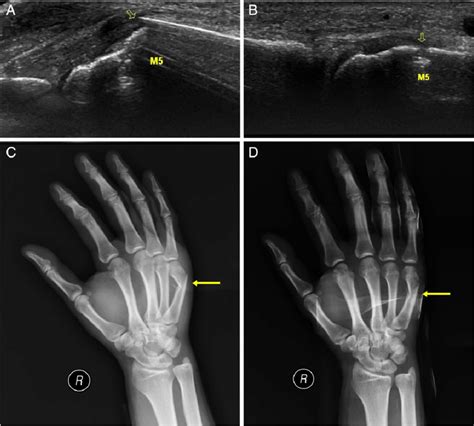 Images From A 32 Year Old Male Patient With A Fifth Metacarpal Fracture