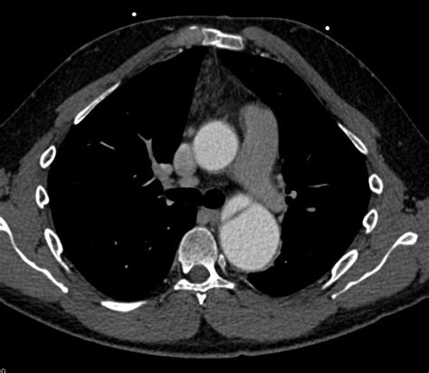 Cta With Ascending Aorta Repair And Dissection Extends