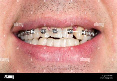 Metal Braces Teeth Hi Res Stock Photography And Images Alamy