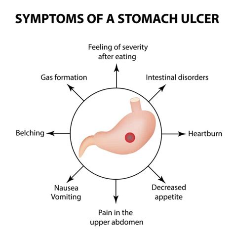 Most Common Symptoms Causes And Home Remedies Of Stomach Ulcer Be