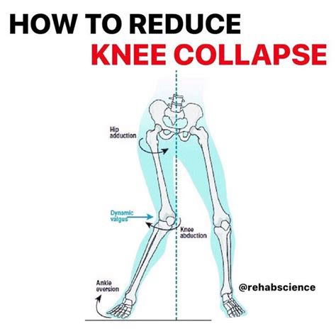 Medial Valgus Knee Collapse Is Often Observed In Individuals Who