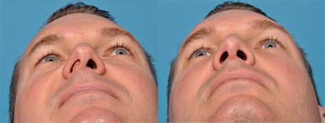 For others, a nose injury causes it. How Much Does a Septoplasty Surgery Cost? - FlyMedi