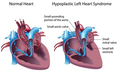 Causes And Symptoms Of Hypoplastic Left Heart Syndrome