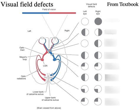 Naming Visual Field Defects Diagram Quizlet