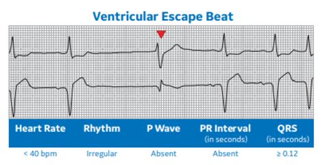 Arrhythmia Recognition Part 2 Clinical View