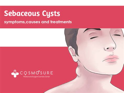 Sebaceous Cysts Symptoms Causes And Treatments Cosmosure Clinic