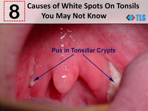 PPT Causes Of White Spots On Tonsils You May Not Know PowerPoint Presentation ID