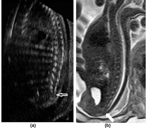 MRI Evaluation Of Fetal Tethered Cord Syndrome Correlation With Ultrasound Findings And