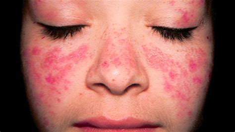 Rash Lupus Pictures Symptoms Symptoms Of Disease
