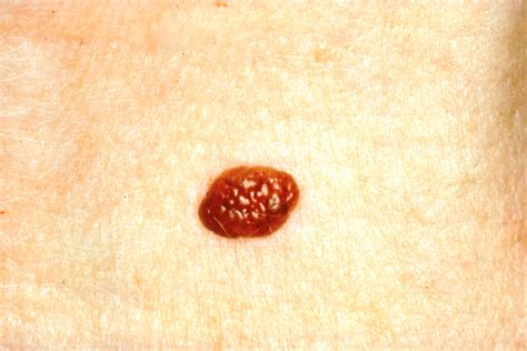 12 Cancerous Moles Early Signs ~ Advanced Melanoma Symptoms