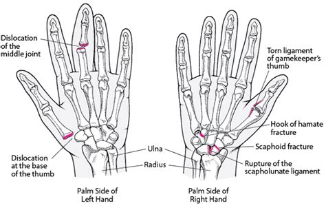 Figure Common Hand Injuries Msd Manual Consumer Version