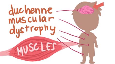 Duchenne Muscular Dystrophy The Brain YouTube