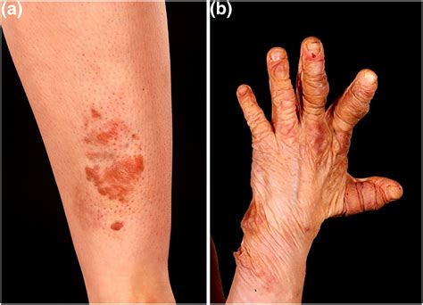 The Role Of Cutaneous Manifestations In The Diagnosis Of The Ehlers