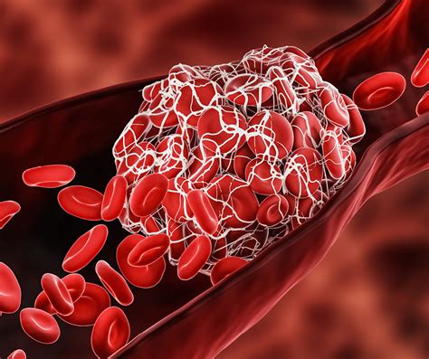 Blood Clots What You Need To Know And How To Help Prevent Them