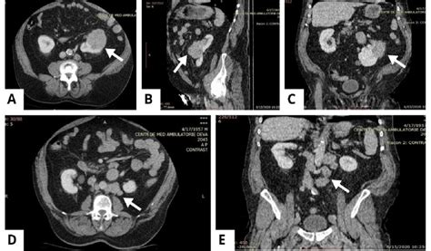 Contrast Enhanced Abdominopelvic Ct Scan Left Renal Tumoral Mass On