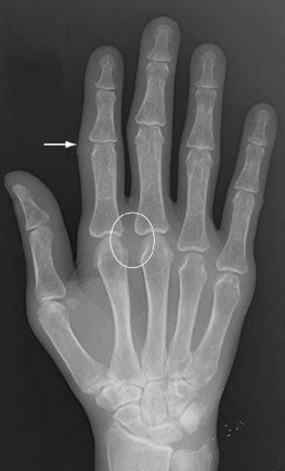 Imaging Of Rheumatoid Arthritis Radiology Key