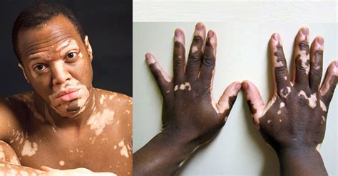 Vitiligo Causes And Treatments What Triggers Vitiligo