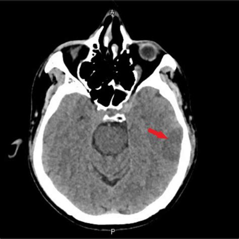 Ct Head Showing Hypodense Lesion In Left Temporal Lobe Arrow Possible