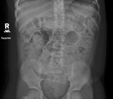 X Ray Of The Abdomen Shows A Large Amount Of Fecal Material Throughout