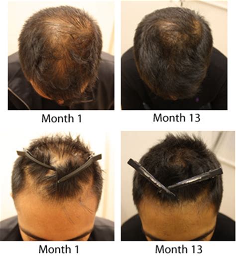 Keratin is a structural protein in the human body that makes up hair, nails and the outer layer of skin. Biotin Hair Growth: Biotin Hair Growth For Men Pattern ...