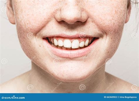 Teeth Smile Mouth Young Beautiful Freckles Woman Face Portrait With Healthy Skin Stock Image