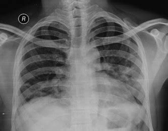 Chest Radiograph Showing Partial Resolution Of Bilateral Opacities