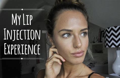 My Lip Injection Experience With Juvéderm Mackenzie Salmon Lip
