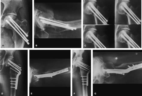 Femoral Neck Nonunion Treatment Clinical Orthopaedics And Related