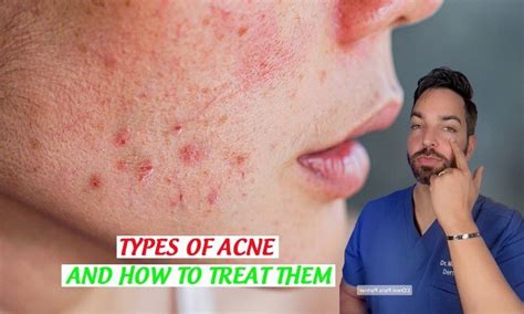Types Of Acne And How To Treat Them Recipe Ideas Product Reviews And