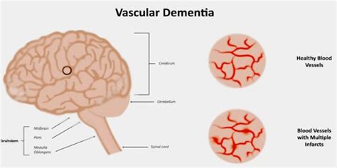 The term is used to describe a cluster of symptoms. Vascular Dementia - Assignment Point
