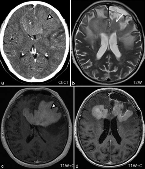 Different Facets Of Intracranial Central Nervous System Lymphoma And