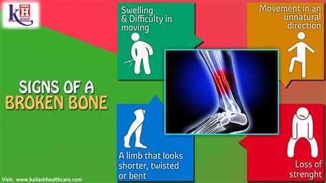 Signs Of A Broken Bone