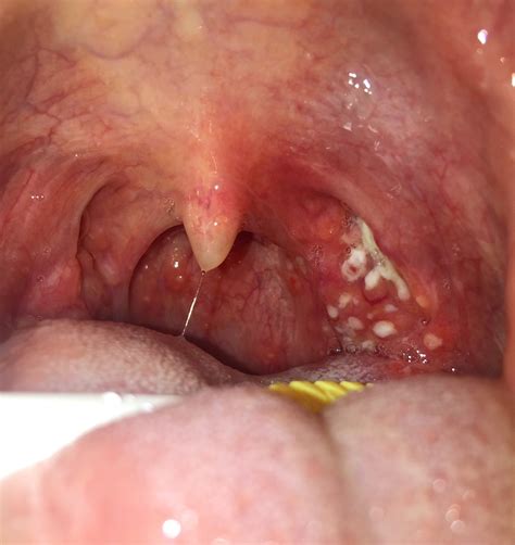 Throat White Spots On Tonsils My XXX Hot Girl