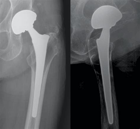 Depuy Pfc Total Hip Prosthesis Implant 200923