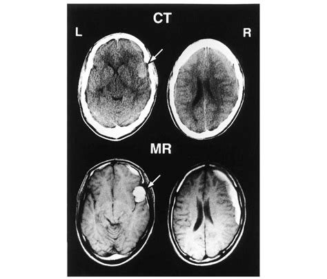 Patient 3 Upper Ct Scans Showing A High Density Subdural Hematoma In