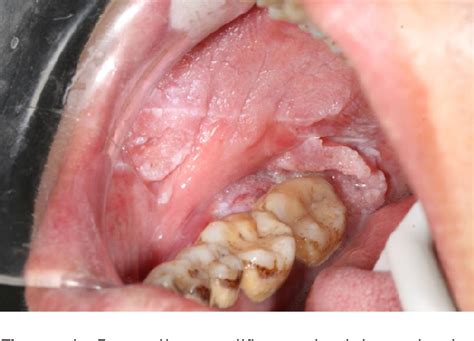Figure 1 From Verrucous Carcinoma Associated With Oral Submucous