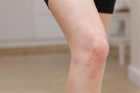 Skin Allergies Legs Skin Women Closeup Of Red Pustules On A Knee An