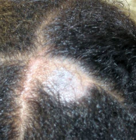 Fungal Infection In Hair Malayhaxac