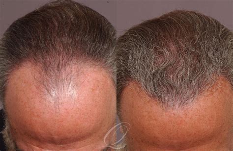 Male Hairline And Central Density Hair Restoration Before After