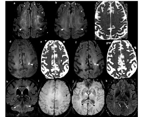 Panels A L Brain Mri Findings In The Five Study Patients Panels A