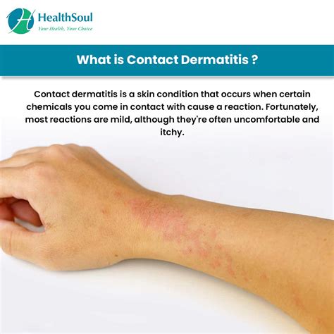 Contact Dermatitis Treatment Brownploaty