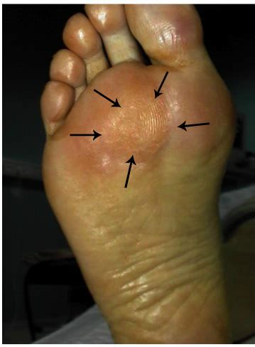 Dott Raffaello Riccio Foot Shape Function La Metatarsalgia