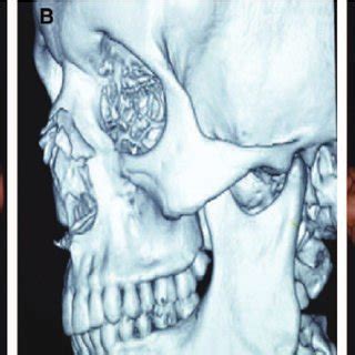 A, Left zygomatic fracture sustained 3 days before ...