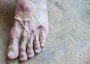 Other symptoms include weight gain, depression, muscle aches, and fatigue. Foot Cancer - Kinds of Foot Cancer - Vascular Health Clinics