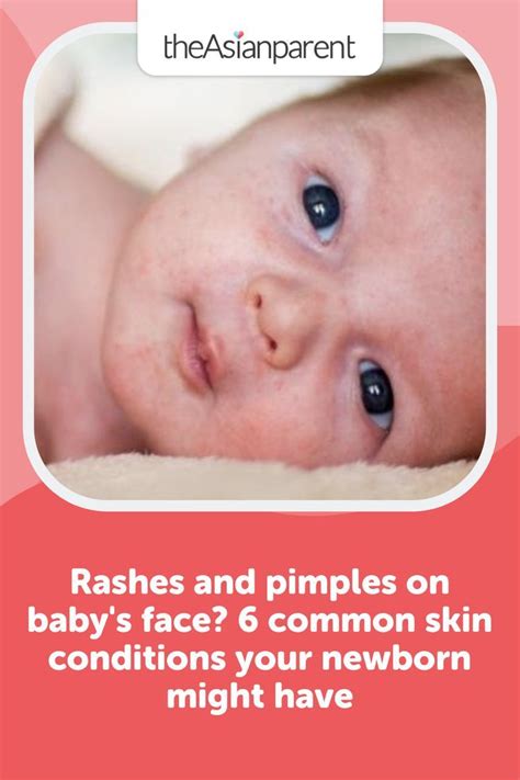 6 Common Skin Conditions Your Newborn Might Have Baby Face Pimples