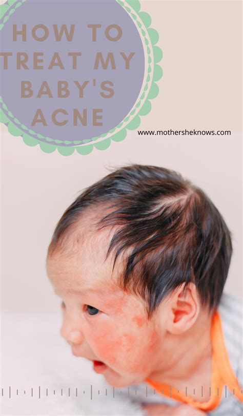 How To Treat Babys Acne In 2020 Baby Acne Acne Baby Cleaning Products