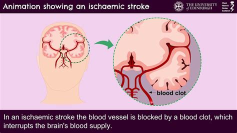 Animation Showing An Ischaemic Stroke Youtube