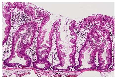 Histopathology Images Of Polyp Hyperplastic Colon By